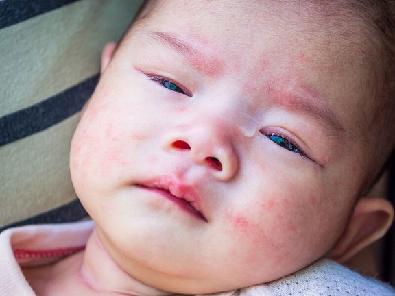 nesselsucht_baby.jpg